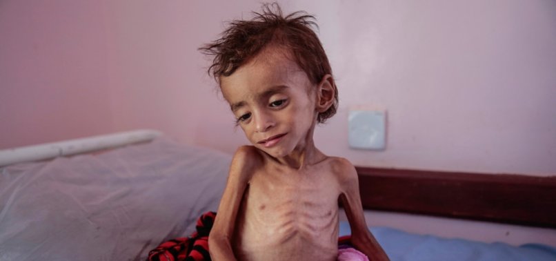 Миллионы йеменских детей страдают от острого недоедания
